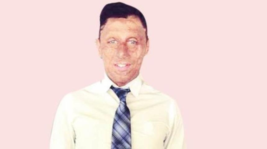 Asit yanığına 12 yıl sonra tazminat