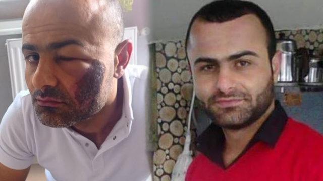 Lazer epilasyon yaptırmak istedi, hayatı kabusa dönüştü! 'Sanki suratıma kaynak yapıyor'