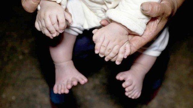 Çin'de 31 parmaklı bir bebek doğdu