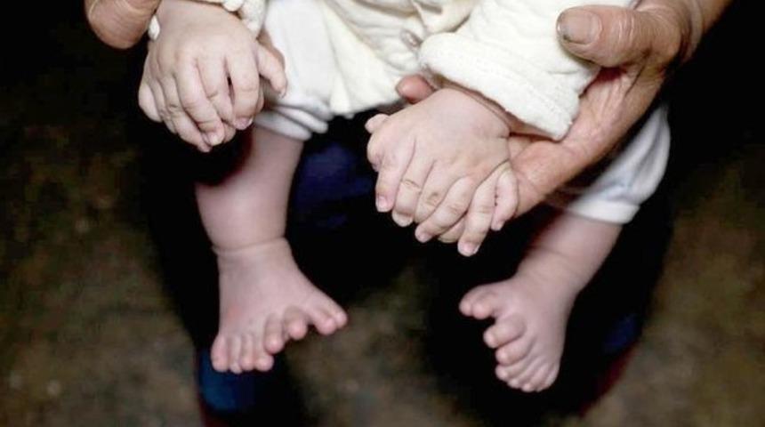 &Ccedil;in'de 31 parmaklı bir bebek doğdu