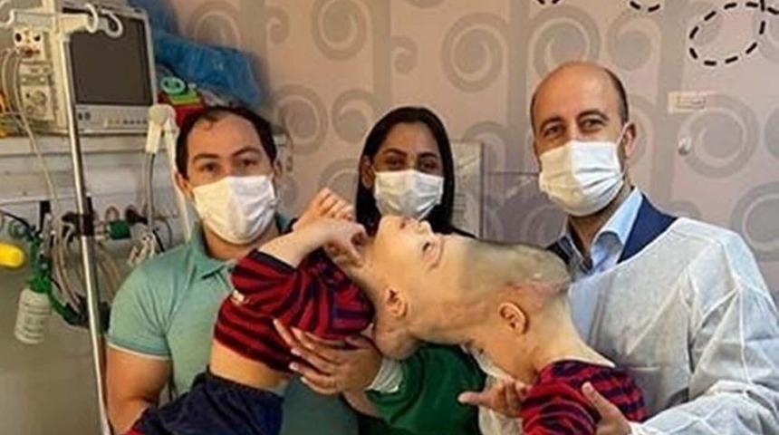 Operasyon tam 27 saat sürdü! Beyinleri kaynaşan yapışık ikizler...