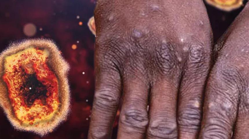 Art arda ölüm haberleri geliyor! Dünyada maymun çiçeği virüsü alarmı