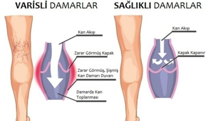 Varis nedir nasıl oluşur? 