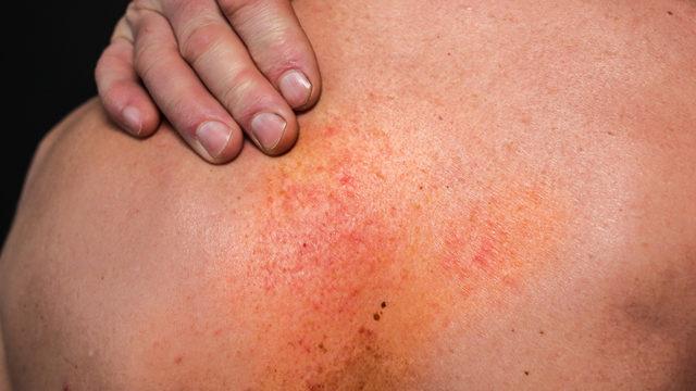 Yaz aylarının favori yiyeceği egzamayı azdırıyor