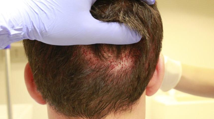 Tıraşsız sa&ccedil; ekimi m&uuml;mk&uuml;n