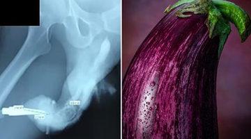 Seks hayatları başlarına bela oldu: Cinsel organı patlıcana dönüştü