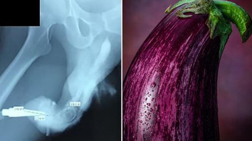 Coşkulu seks hayatları başlarına bela oldu: Cinsel organı patlıcana dönüştü