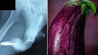 Coşkulu seks hayatları başlarına bela oldu: Cinsel organı patlıcana dönüştü