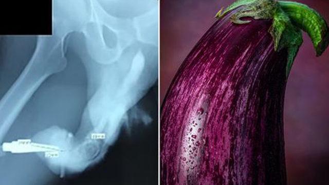 Coşkulu seks hayatları başlarına bela oldu: Cinsel organı patlıcana dönüştü