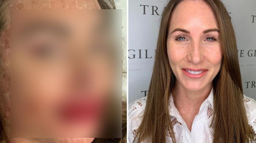 İbretlik değişim! Yaptırdığı estetik ameliyat sonrası...