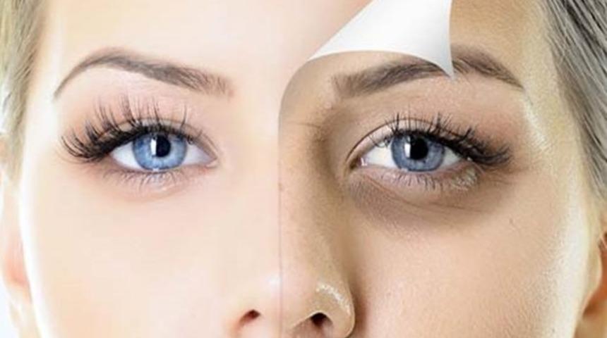 Göz altı morlukları nasıl geçer? Göz altı morlukları tedavisi nasıl olur?