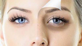 Göz altı morlukları nasıl geçer? Göz altı morlukları tedavisi nasıl olur?