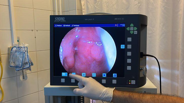 Nefes darlığı şikayetiyle başvurduğu hastanede genzinden 4,5 santimetrelik kitle çıkarıldı G4