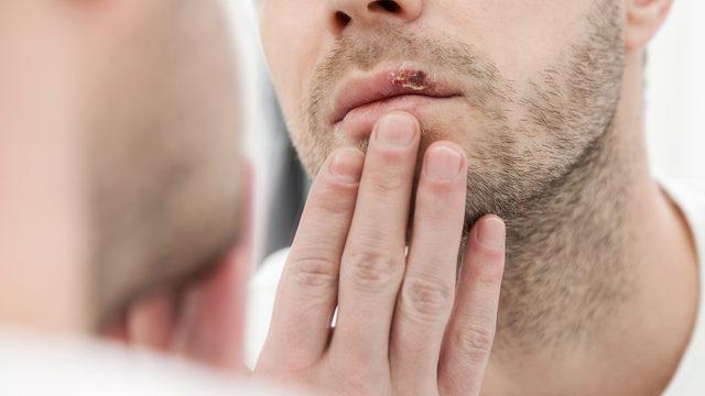 Uçuğu olan herkes dikkat! Ölümcül hastalık uyarısı