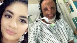 Feci şekilde yanmıştı! 5 haftalık komadan sonra hayata dönen genç kadının kendine seçtiği kariyer şaşırttı