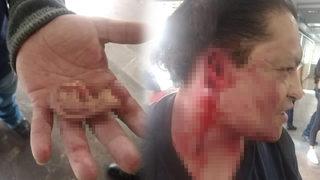 Meksika'da kan donduran olay! Metroda kavga eden iki kişiden biri diğerinin kulağını kopardı