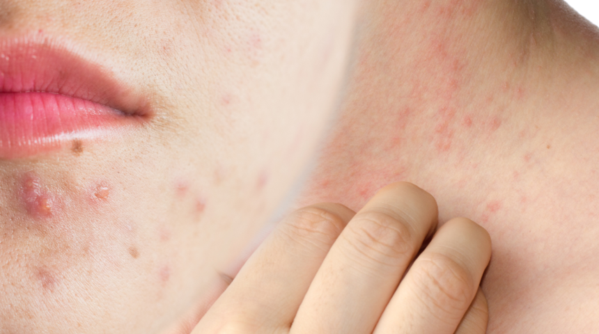 Egzama ve sivilcenin kökünü kurutur! Kozmetik ürünlerin içindeki malzeme