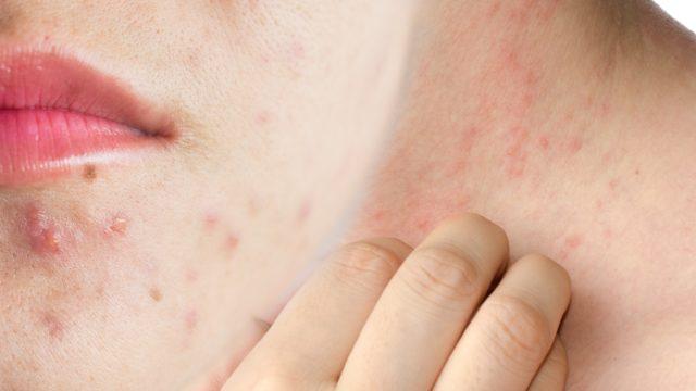 Egzama ve sivilcenin kökünü kurutur! Kozmetik ürünlerin içindeki malzeme