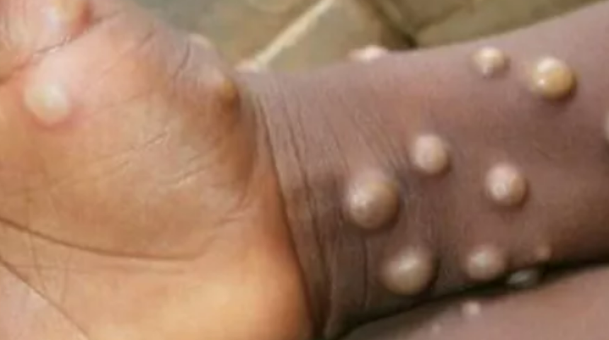 Vaka sayısı 5’e yükselmişti! Maymun çiçeği belirtileri nelerdir, nasıl bulaşır, tedavisi nedir?