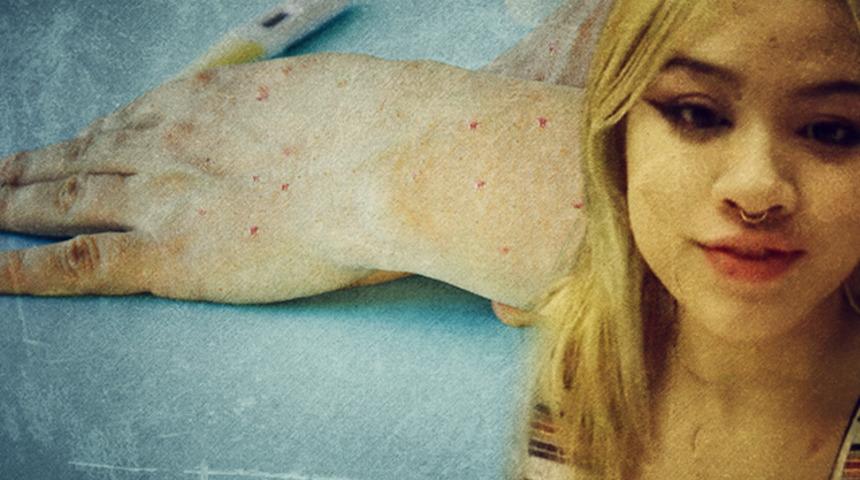 Vücudundaki yaraları görünce maymun çiçeği zannedip uçaktan indirdiler! Sosyal medyadan isyan etti