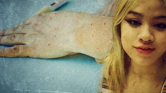 Vücudundaki yaraları görünce maymun çiçeği zannedip uçaktan indirdiler! Sosyal medyadan isyan etti