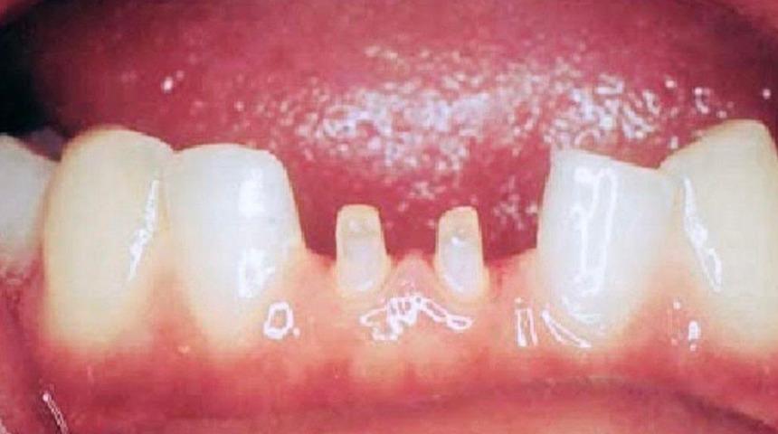 İnci gibi dişler hayal ederken perişan oldu