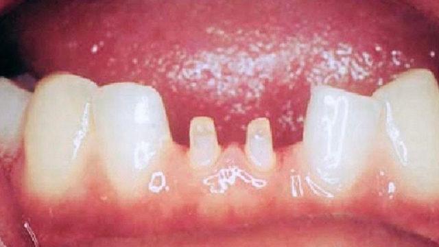 İnci gibi dişler hayal ederken perişan oldu