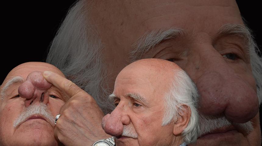 2 yıl önce oluşmaya başladı, burnunu kurcalayıp bu hale geldi! 100 gram ağırlığında