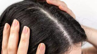 Bu görüntüden kurtulmanın yolu çok basit! Saçta kepek neden olur, nasıl geçer?