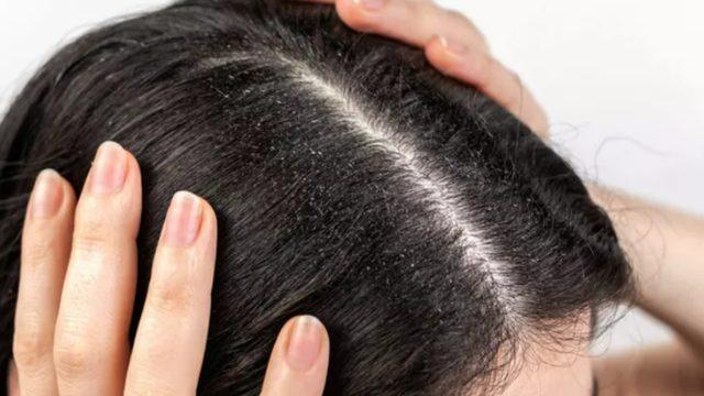 Bu görüntüden kurtulmanın yolu çok basit! Saçta kepek neden olur, nasıl geçer?