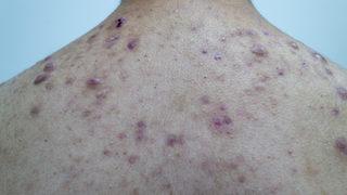 Sivilceli bir vücutta yaşamak zorunda değilsiniz! Sivilceden kurtulmak için...