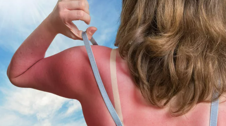 Eczacı öneriyor “Güneş yanıkları için her evde bulunan 5 doğal ilaç” Güneş yanığına ne iyi gelir?