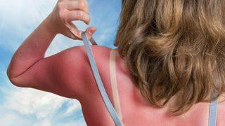 Eczacı öneriyor “Güneş yanıkları için her evde bulunan 5 doğal ilaç” Güneş yanığına ne iyi gelir?