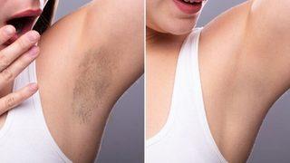 Bu yöntemlerle koltuk altı kararmanızdan kurtulun! Koltuk altı kararması nasıl geçer?