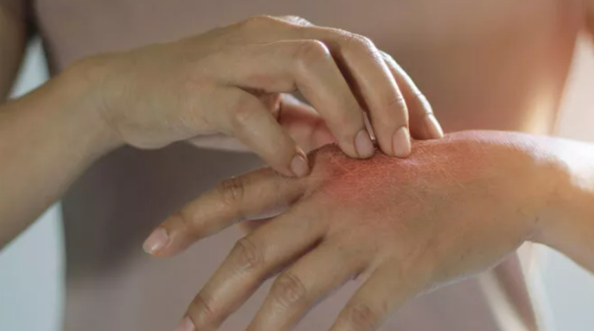 Prof.Dr. İbrahim Saraçoğlu önerdi: Egzamayı geçirecek tarif, Egzama nedir, Nasıl geçer?