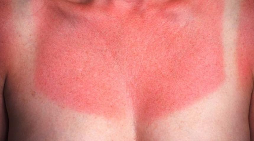 G&uuml;neş yanıklarına karşı basit &ccedil;&ouml;z&uuml;mler 