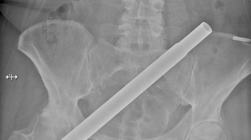 Her şey bir anda oldu! Ayağı kayıp düşen kadının kalçasına metal direk saplandı