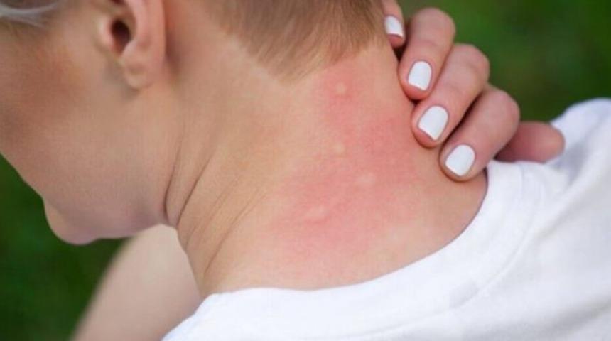 Sivrisinek ısırığı nasıl geçer? Sivrisinek ısırığına ne iyi gelir?