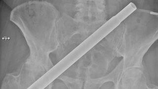 Röntgeni görenin canı acıyor: Metal çubuk saplandı!