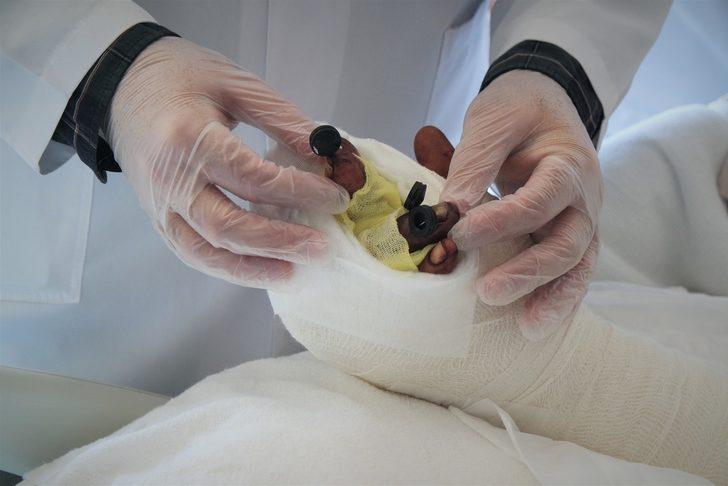 Bursa'da bir işçinin kopan parmakları 10 saatlik operasyonla yerine dikildi G2