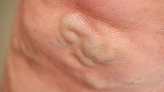 Lenfödem nedir, kimlerde görülür? Nelere dikkat edilmeli?