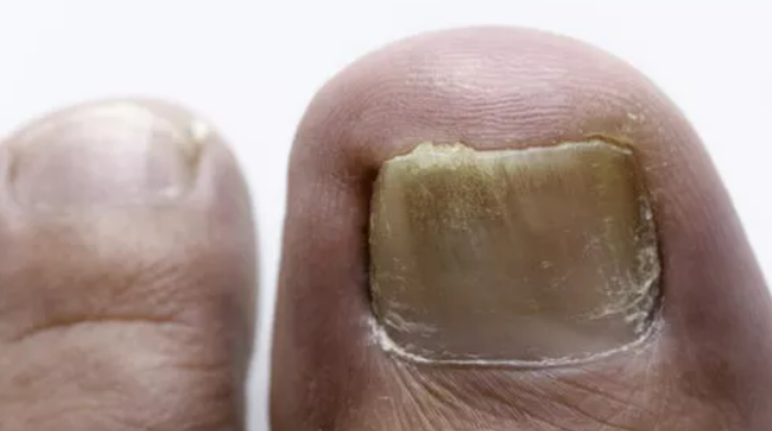 Tırnak mantarının altında yatan neden ciddi olabilir! Tırnak mantarı neden olur? Nasıl bulaşır?