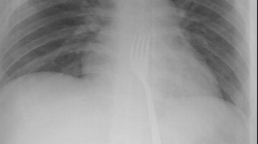 15 santimlik &ccedil;atalı yuttu, ameliyata alındı