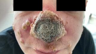 Maymun çiçeği hastalığı bu hale getirdi: Burnu çürüdü