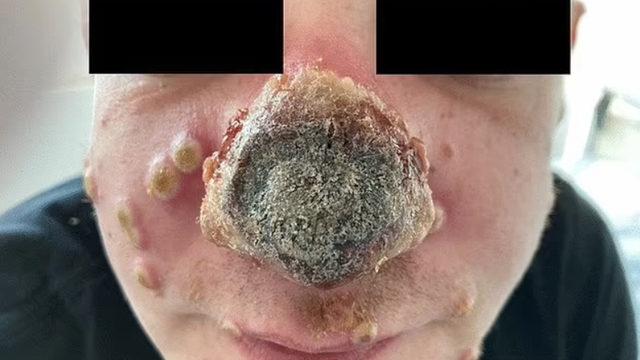 Maymun çiçeği hastalığı bu hale getirdi: Burnu çürüdü