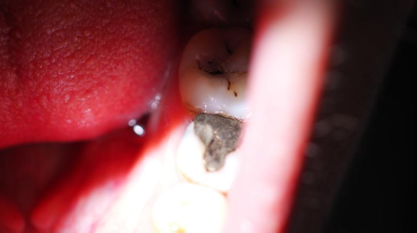 Tek tek dökülmesini mi bekliyorsunuz? Tedavi edilmezse dişsiz kalırsınız: Bruksizm nedir?