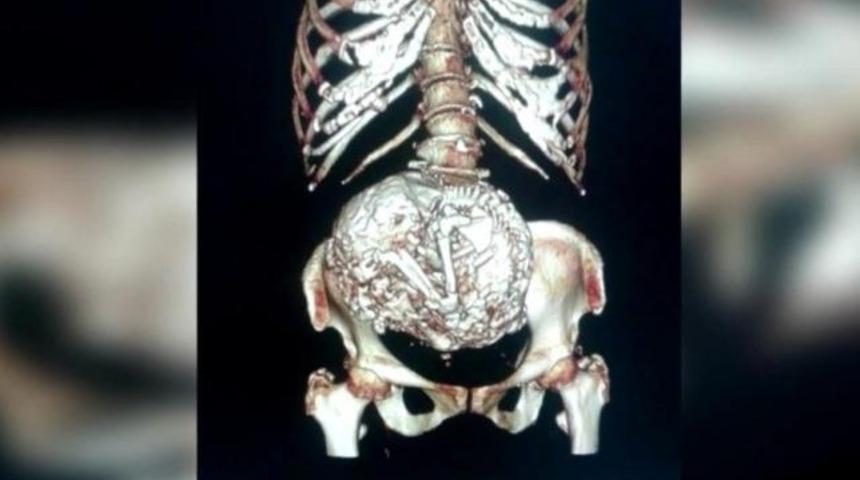 Rahminde 60 yıl boyunca bebeğini taşıdı