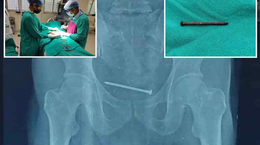 Doktorlar afalladı! 10 cm’lik paslı çivi çıktı