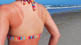 Buzdolabında bekleyen doğal güneş yanığı ilaçları