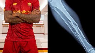 Milli yıldız şokta! Yeni transferin ayağı kırıldı